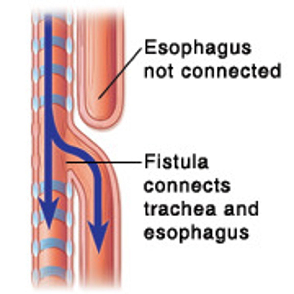 <p>an abnormal connection (fistula) between the esophagus and the trachea</p><p>⢠90% of those with esophageal atresia also have a TEF</p>