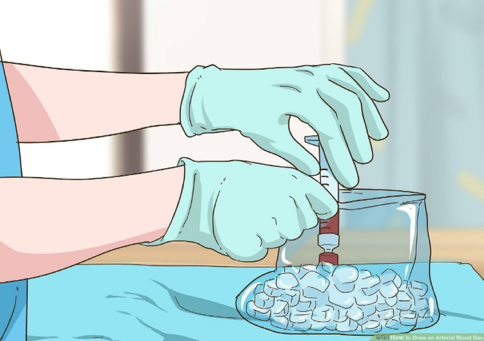 <p>if a plastic syringe used for ABG collection </p><p></p>