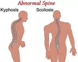 <p>abnormal spinal curvature+vertebral rotation→deformed chest</p>