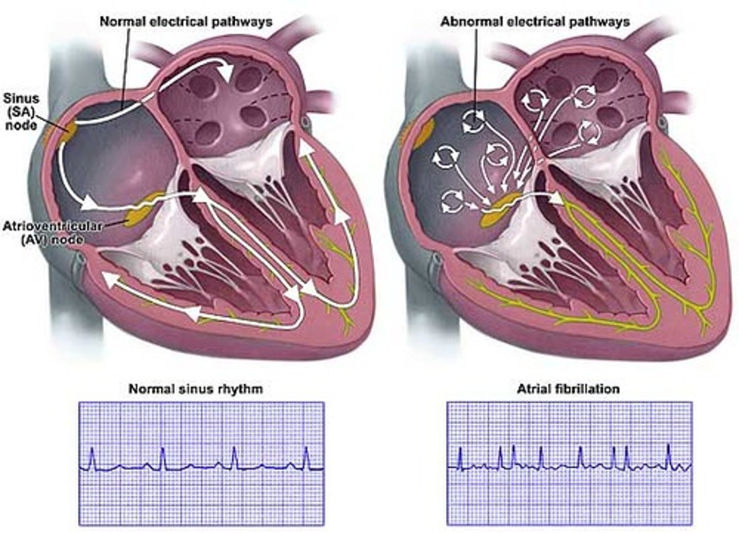 <p>-valvular disease that results in irregular, ineffective heartbeat/contractions in both atria due to damage by disease or infection</p><p>-increases the risk of stroke</p><p>volume overload results when fluid accumulates in lungs causing SOB and this overload increases the risk for AFib</p>