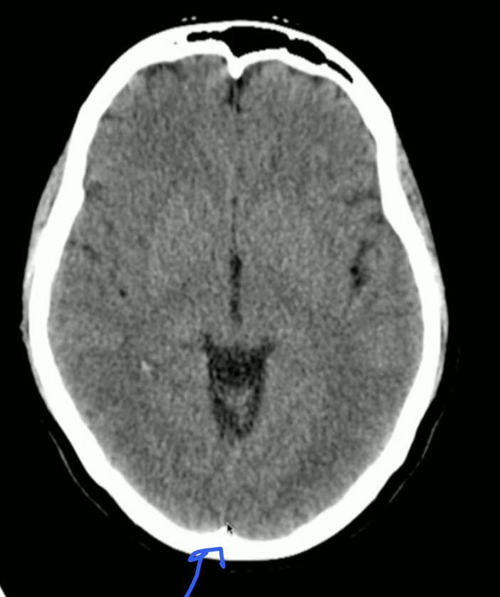 <ul><li><p>Falx Cerebri</p></li><li><p>Anteriorly: Crista Galli on Ethmoid Bone</p></li><li><p>Posteriorly: Occipital Protuberance</p></li></ul><p></p>