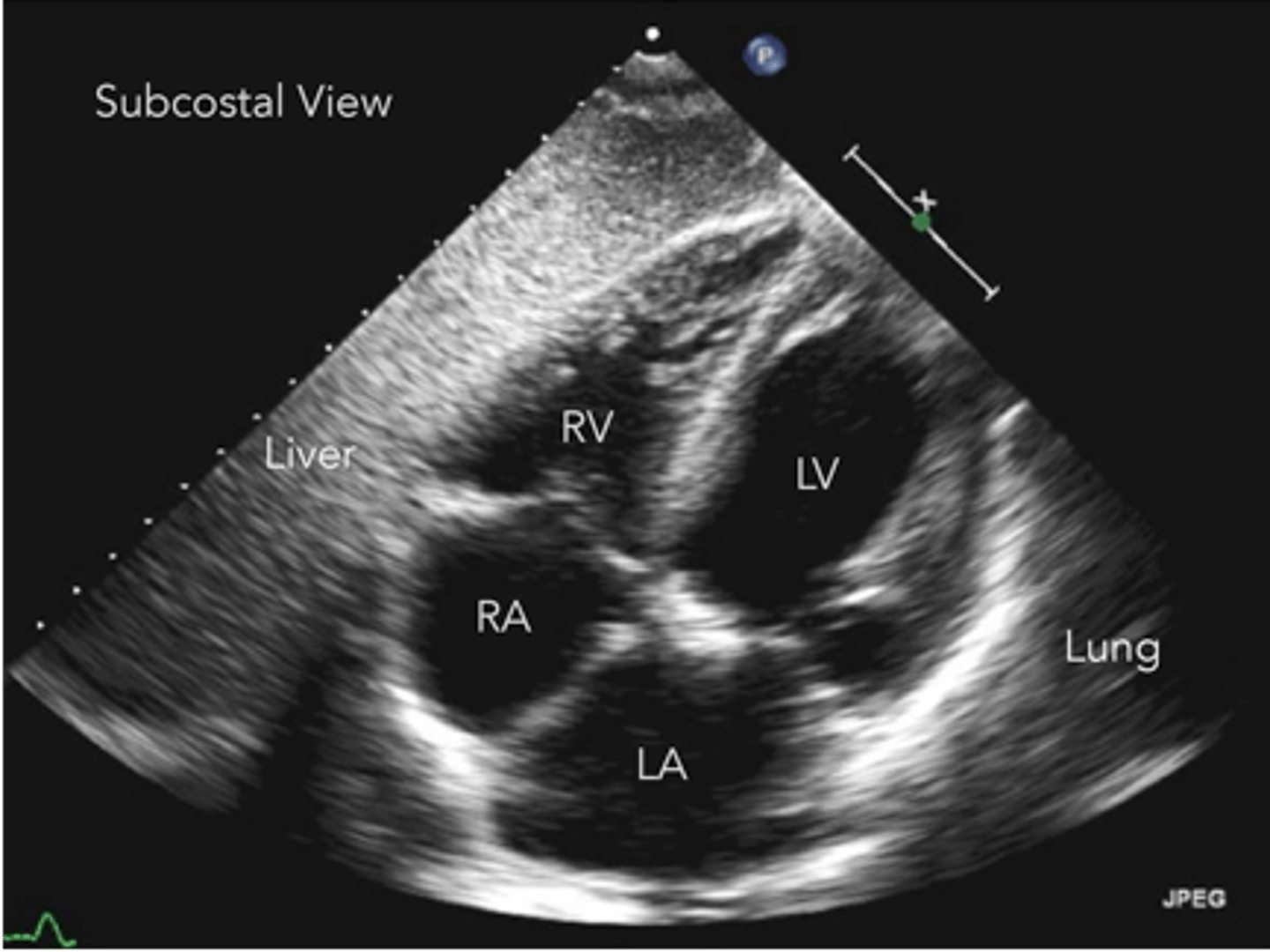 <p>anterior mitral valve leaflet</p>