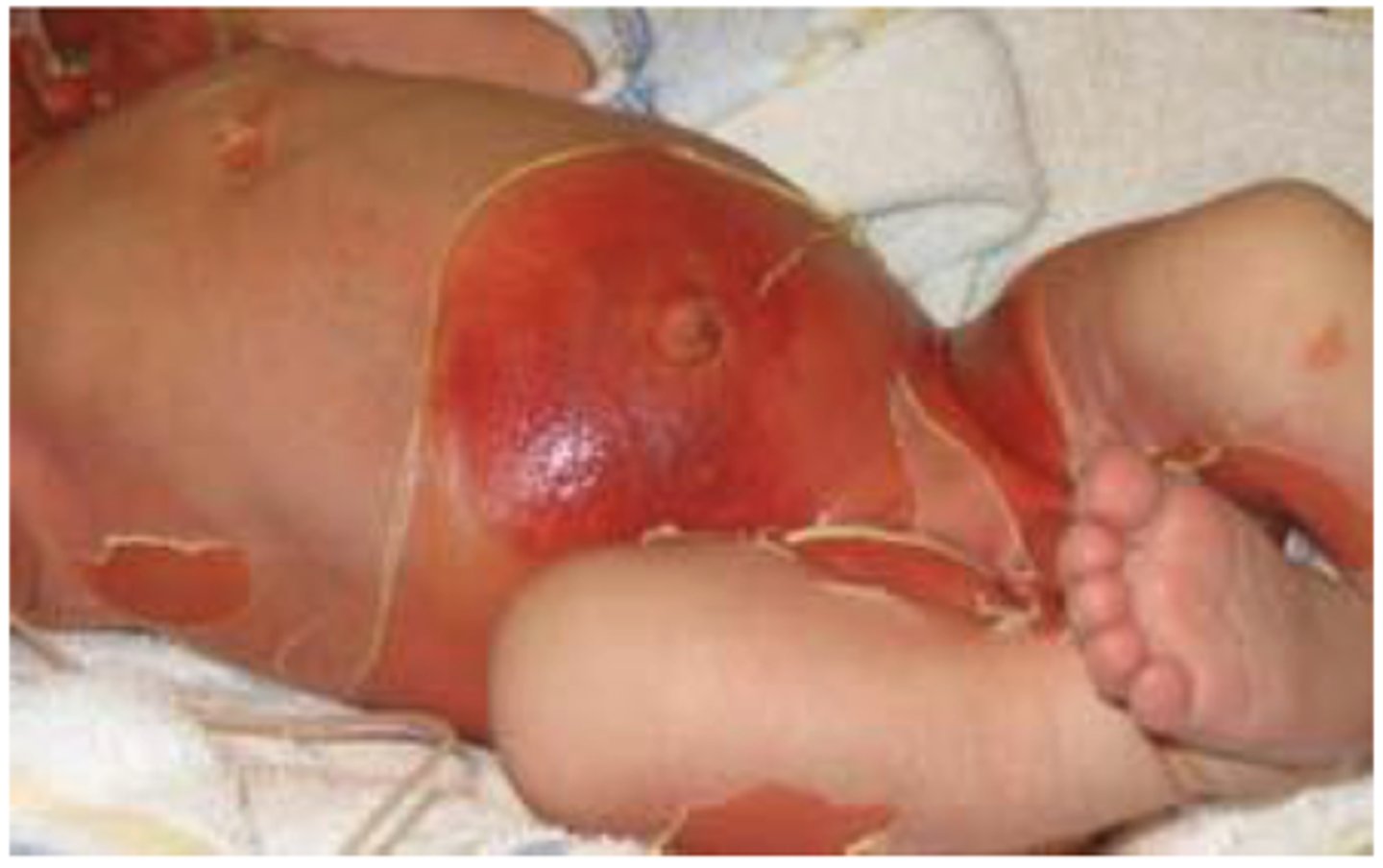<p>syndrome of acute exfoliation of skin , causing top layers of epidermis to slough off</p>