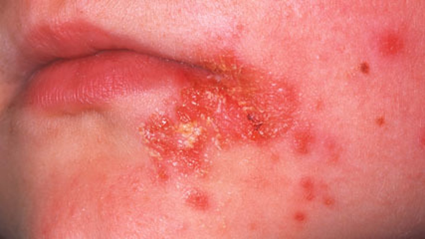 <p>CA: Staphylococcus aureus / Strep pyogenes<br>MOT: -direct skin-contact<br>Si/Sx: -erythemic sores around mouth&amp;nose -golden crusting -rashes/blisters<br>Dx: -Hx -PE -bacterial cultures<br>Tx: -ABX (mupirocin ointment) -PCN</p>