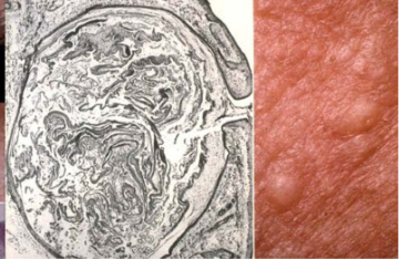 <p>white head acne (closed comedone) </p>