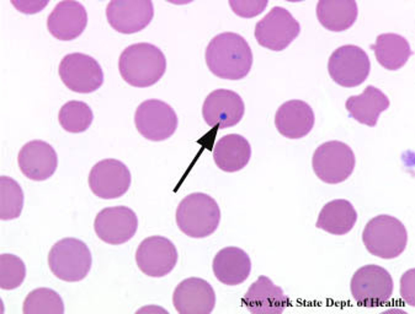 <p>-DNA inclusion<br>splenectomy, anemias</p>