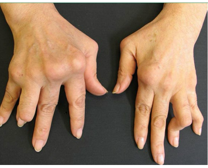 <p>What deformity is this?</p><p>-Associated with RA, characterized by a flexed PIP joint and extended DIP joint, creating a “button hole” appearance </p>