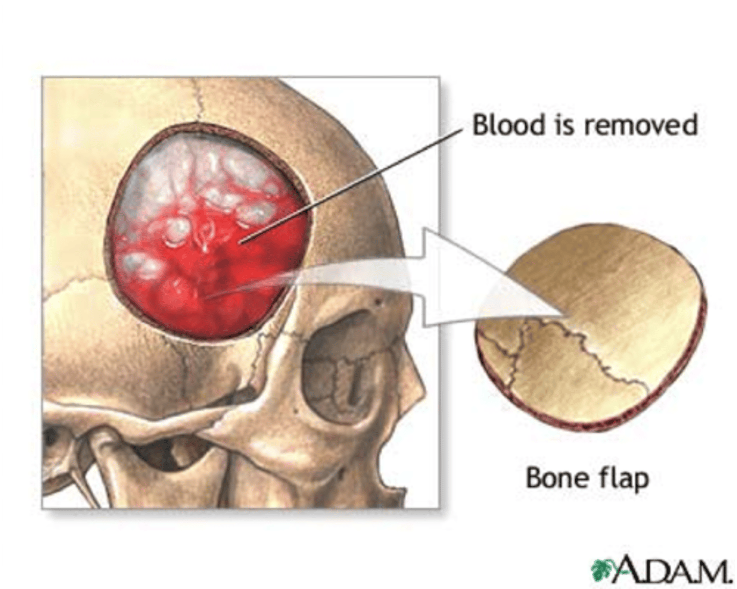 <p>evacuate hematomas, remove bone fragments, remove foreign objects, by removing a portion of the skull to expose the brain</p>