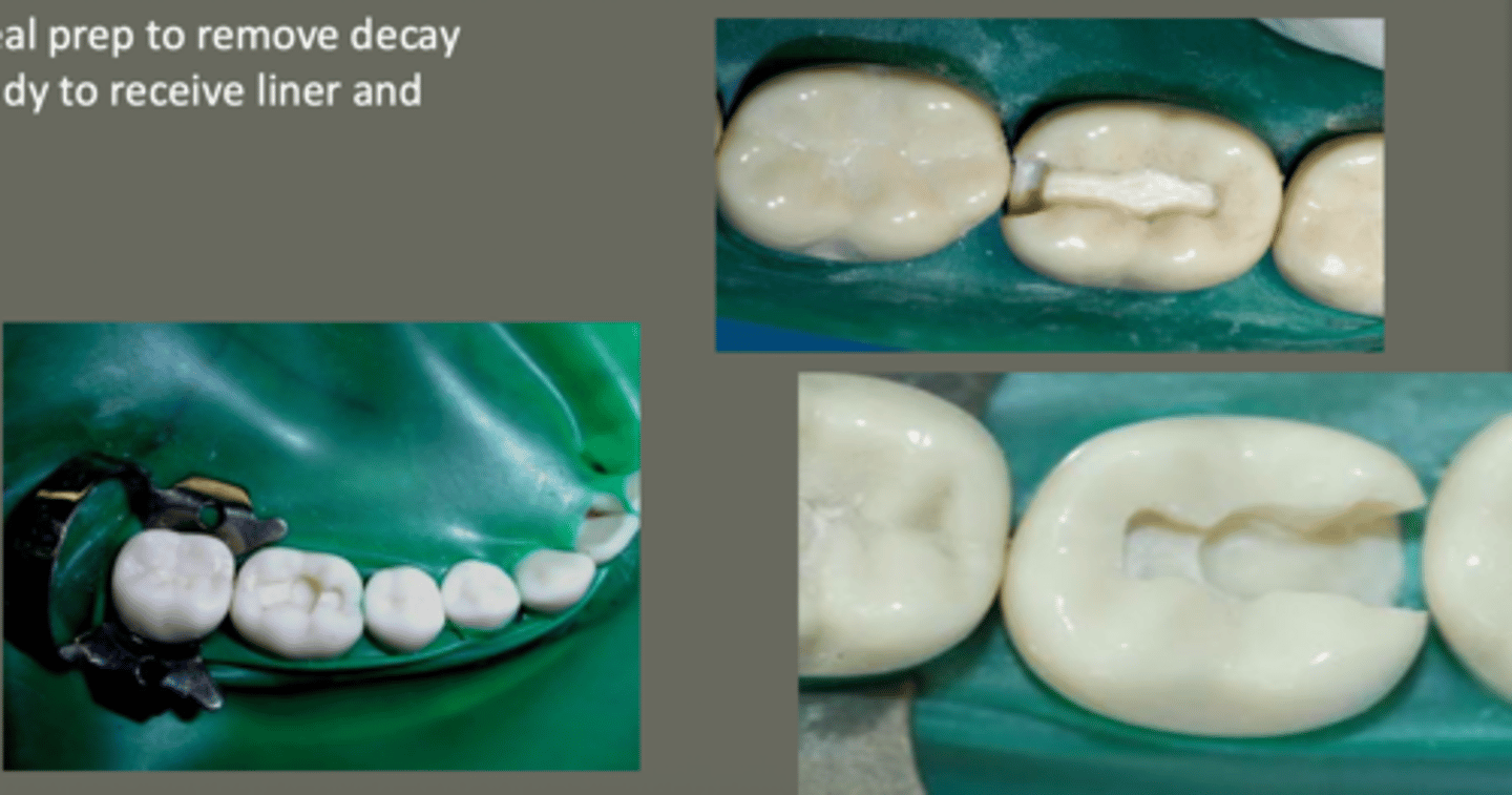 <p>extend ideal prep to remove decay</p><p>prep is ready to receive liner &amp; base</p>