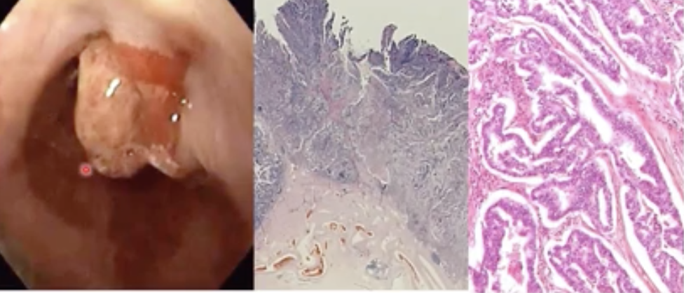 Adenocarcinoma, when the cells penetrate the muscular layer