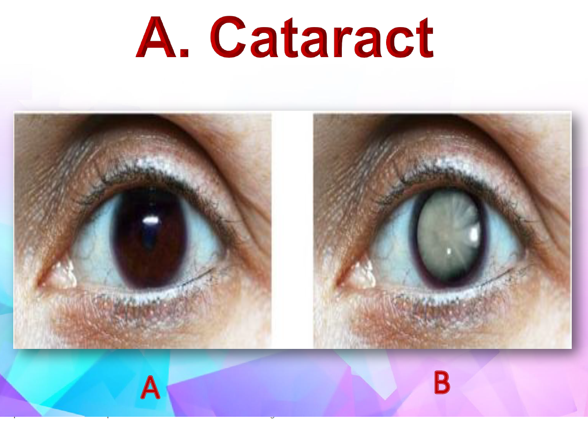 <p>What is cataract ?</p>