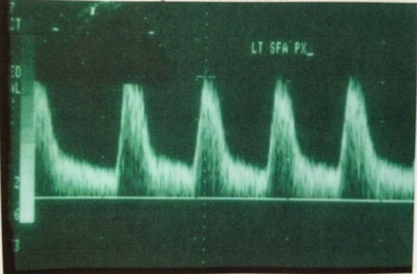 <p>vascular flow yielding a single phase</p>