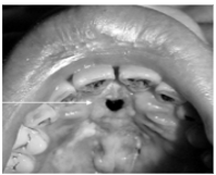 <p><span style="background-color: transparent; font-family: "Times New Roman", serif;">*Rare, affects mainly <strong>adults</strong></span></p><p><span style="background-color: transparent; font-family: "Times New Roman", serif;">*Most frequent in <strong>Asian, Guatemalan, & Peruvian</strong> </span></p><p></p><p><span style="background-color: transparent; font-family: "Times New Roman", serif;">*<strong>Destruction of midline structures of palate and nasal fossa</strong></span></p><p><span style="background-color: transparent; font-family: "Times New Roman", serif;">*Pain, nasal stuffiness, epistaxis, swelling of palate, </span></p><p><span style="background-color: transparent; font-family: "Times New Roman", serif;">ulceration, oral-antral communication</span></p>