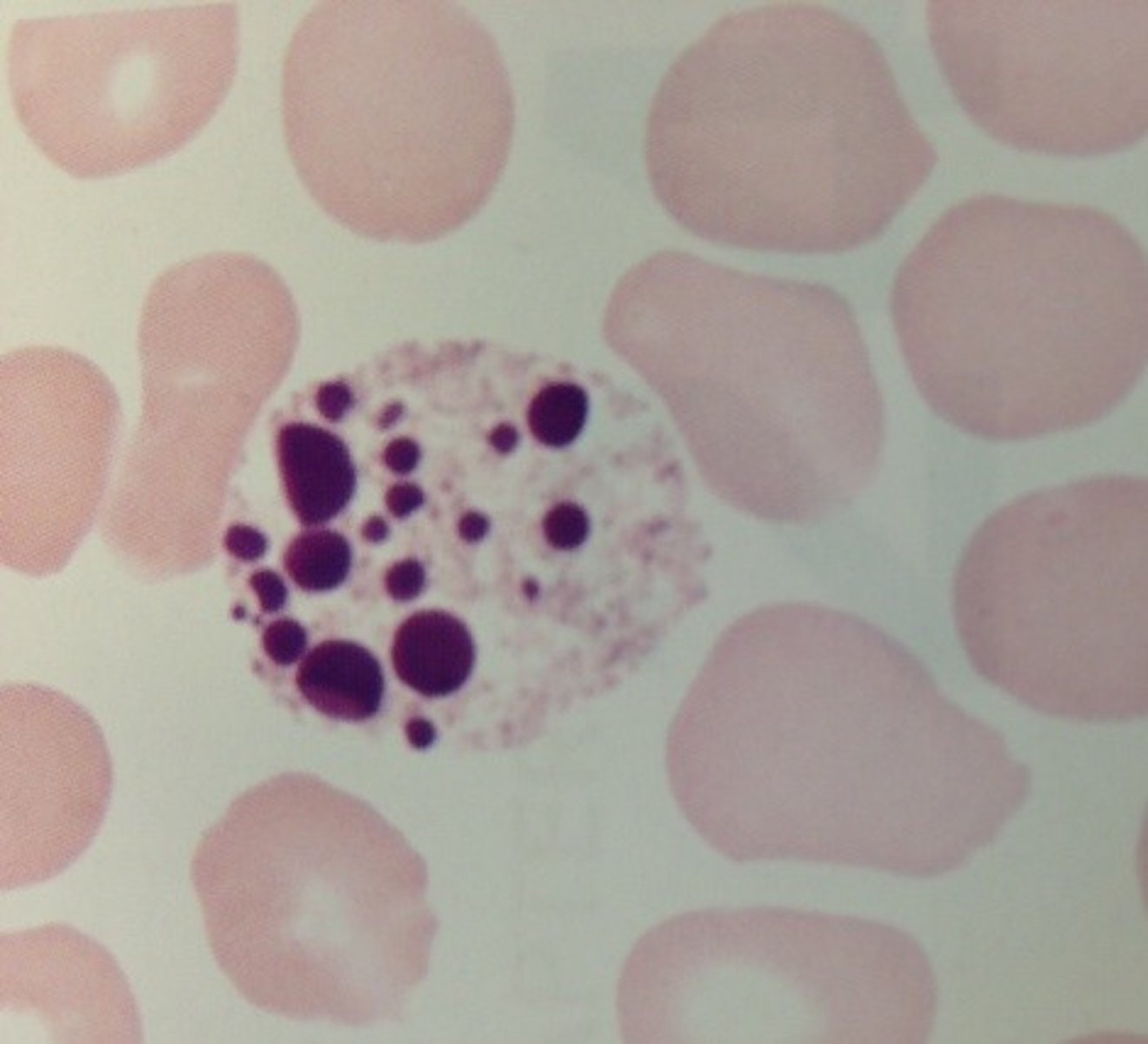 <p>- Degenerating cells</p><p>- Variable nuclear shape</p><p>- Multiple lobes, varying in size and shape w/o connecting filaments</p><p>- Dark, homogenous, dense chromatin</p>
