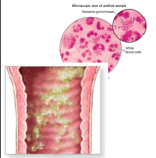<p>a <strong>greenish and purulent</strong> vaginal discharge</p>
