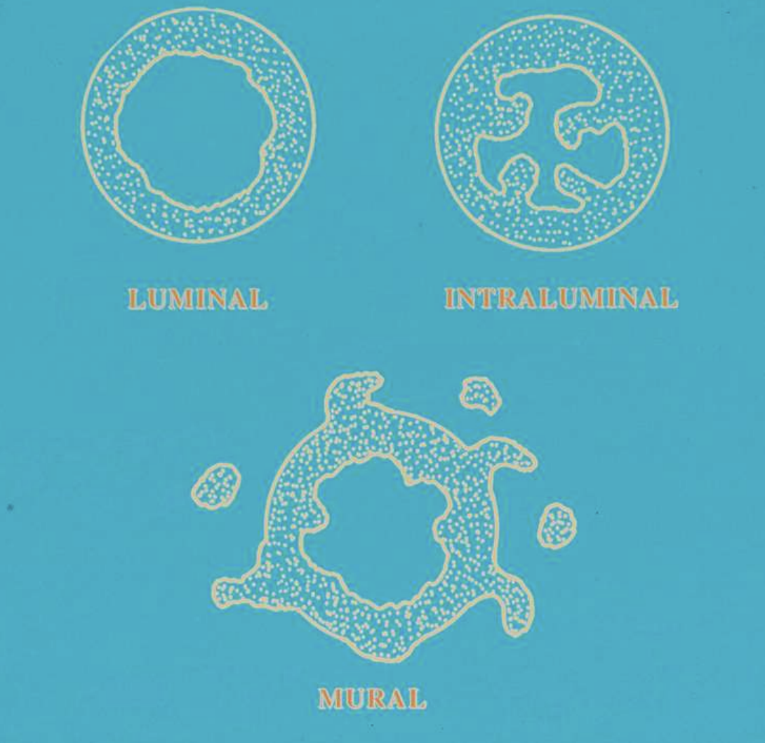 <ol><li><p>luminal type → tumor confined to luminal surface</p></li><li><p>intraluminal type → tumor nodules project from lining into lumen</p></li><li><p>mural type → tumor islands in wall of cyst</p></li></ol><p></p>