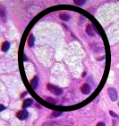 <p><strong>Acino </strong>Mucoso (es pálido en medio)</p>