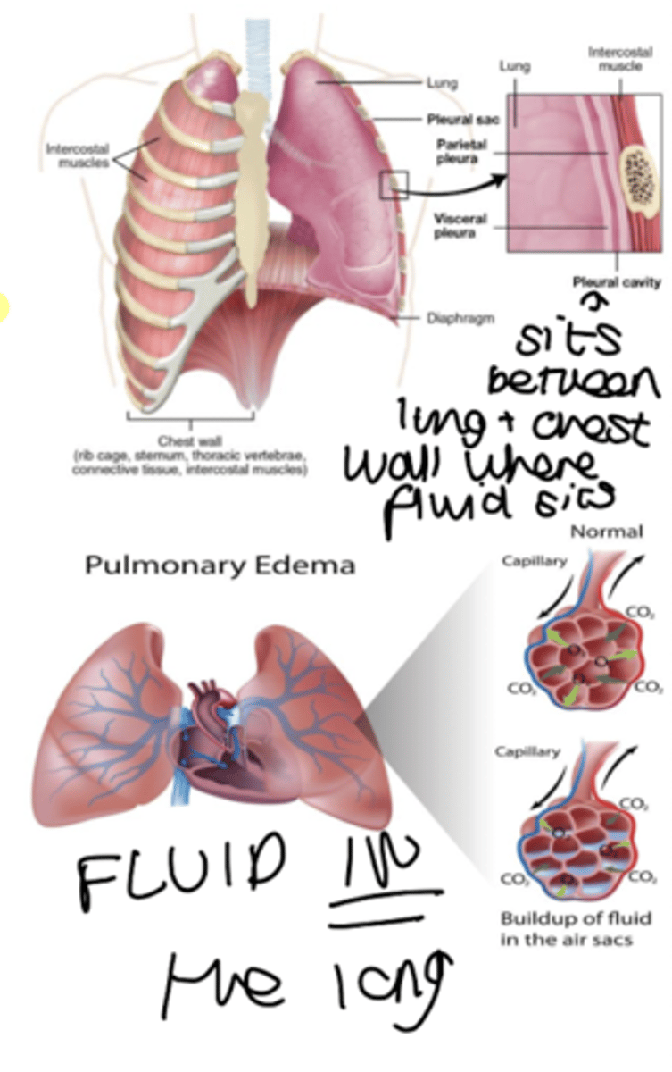 <p>pleural effusion - fluid on the lung</p><p>pulmonary oedema - fluid in the lung</p>