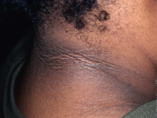 <p>acanthosis nigricans characteristic</p>