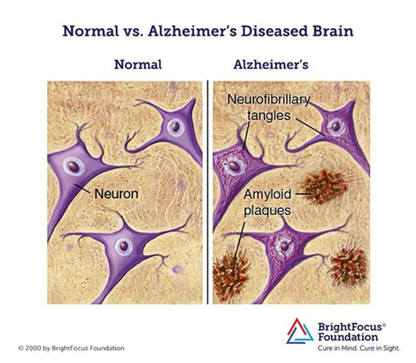 <p>patches of degenerating nerve terminals around a core of β-amyloid protein (Aβ)</p><p>- EC lesions found in the brain and cerebral vasculature</p><p>- form due to an imbalance between Aβ production and clearance, leading to accumulation of the proteins</p><p>- it is unknown if Aβ inside or outside of plaques is responsible for pathogenesis!</p>