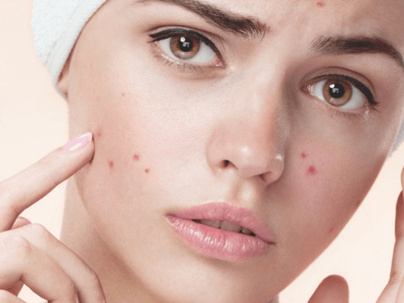 <p><span>pimpled face</span></p><p><span>pimple </span></p>