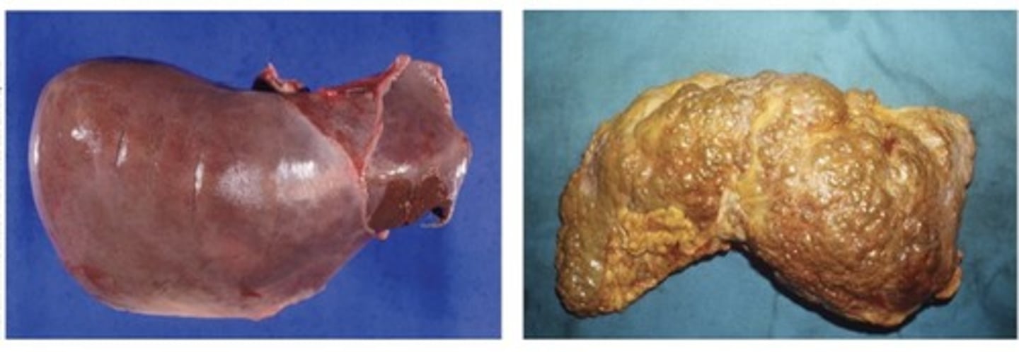 <p>Cirrhosis is an irreversible condition where fibrous scar tissue replaces normal liver tissue, interfering with liver function.</p>