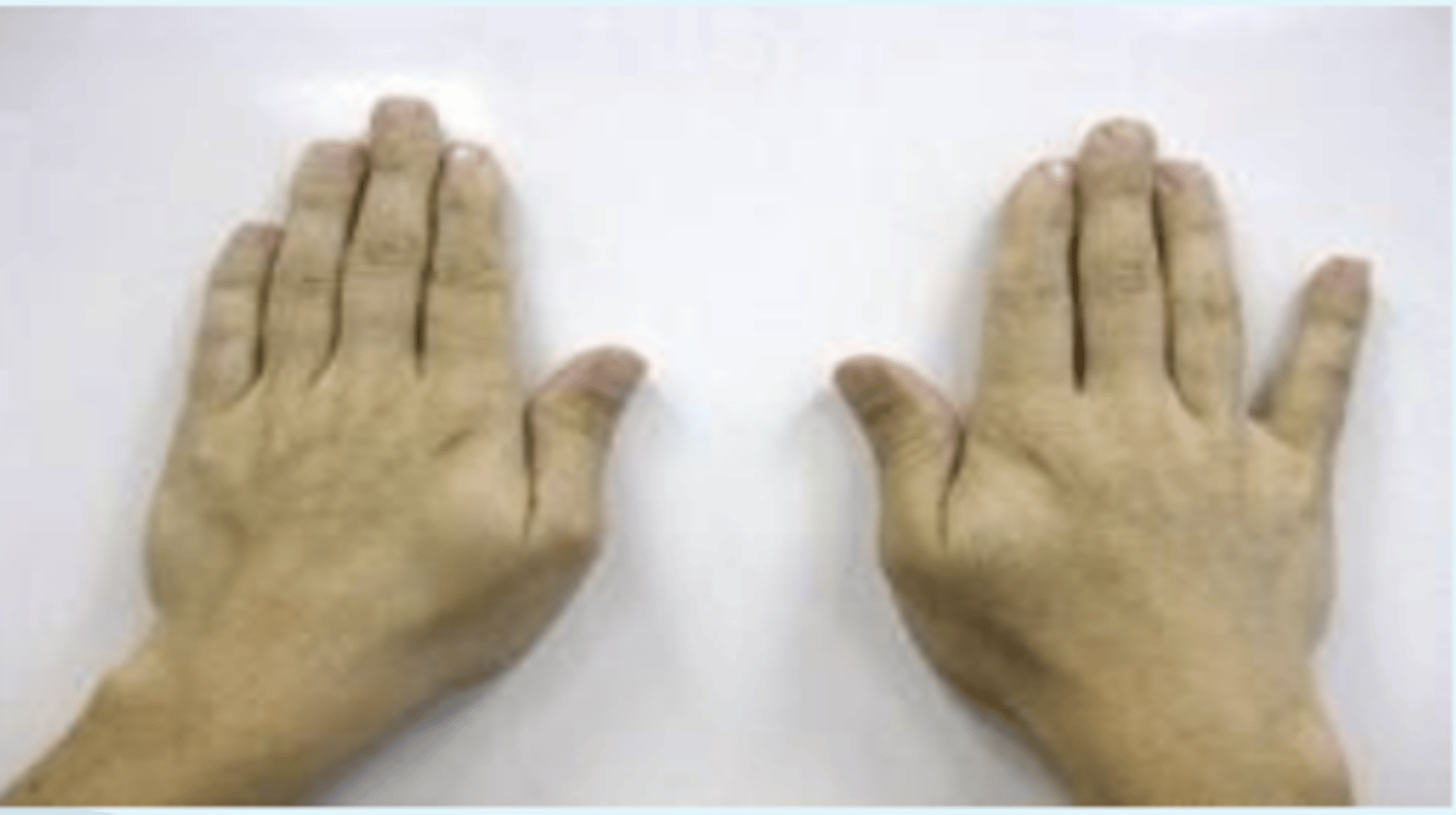 <p>- ulnar nerve neuropathy</p><p>- palmar interossei paralysis = results in small finger being more abducted relative to unaffected side, due to unopposed pull of extensor digiti minimi and extensor digitorum</p><p>(+): inability to squeeze little fingers to the remainder of the hand indicates a positive test for ulnar neuropathy</p>