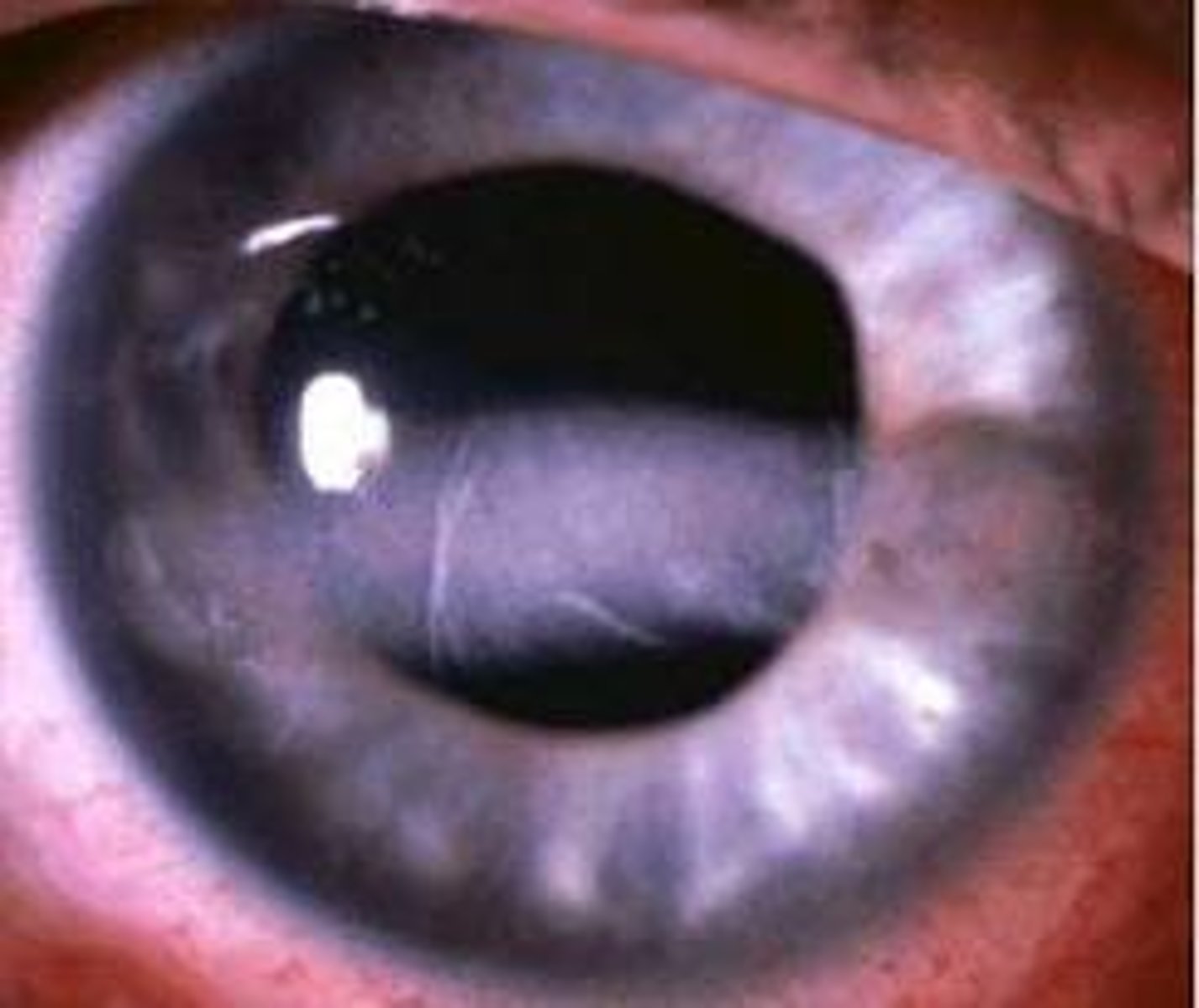 <p>Information for Condition:</p><p>Calcium deposits in Bowman layer; metastatic calcification (may be due to hypercalcemia)</p>