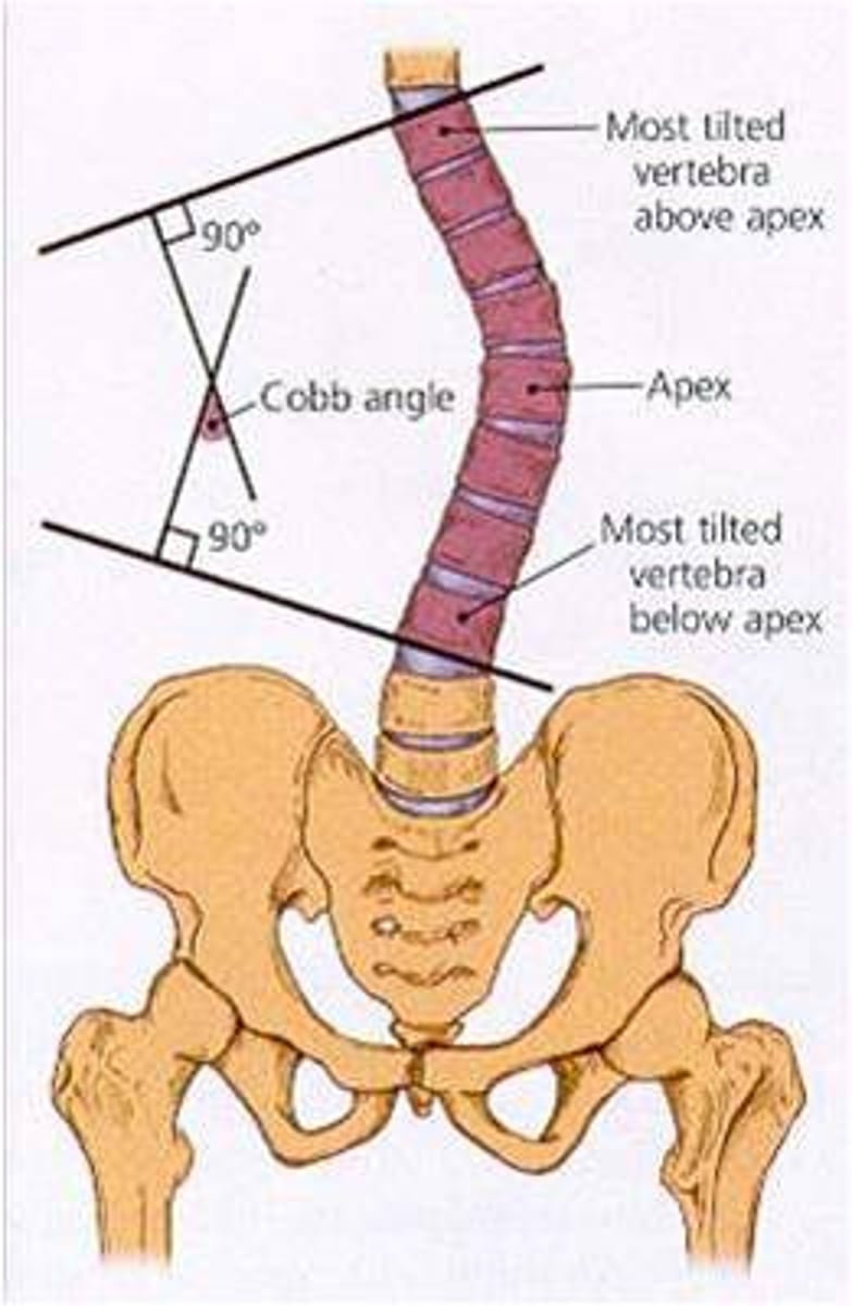 <p>measures the degree of curvature seen on XR</p><p>- request this w/ PA XR order (laterals are often obtained as well)</p>