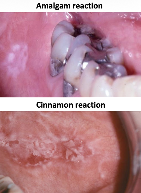 <p>What is Lichenoid Mucositis?</p>