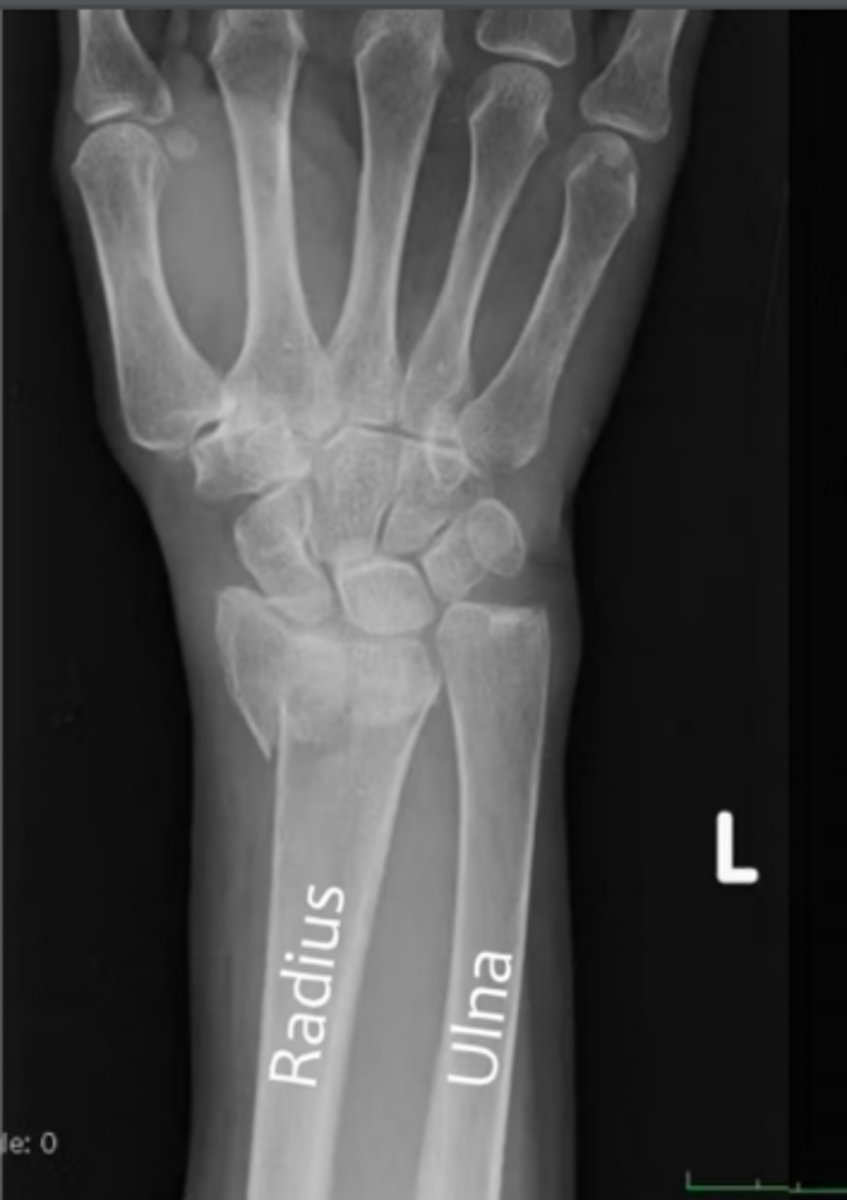 <p>What fracture is observed in this x-ray image?</p>