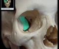 <p>Location: Sphenoid bone (greater wing) Orbit (lateral wall) Description: Smooth, quadrilateral bony surface Forms posterior part of lateral wall of orbit Contributes to superior orbital fissure Contributes to inferior orbital fissure </p><p>Comment: Lateral orbital wall formed by greater wing of sphenoid (orbital surface) and zygomatic bone (orbital surface) Superior orbital fissure formed by body, greater wing, and lesser wing of sphenoid, and frontal bone (orbital surface) Superior orbital fissure transmits ophthalmic (CN V1), oculomotor (CN III), trochlear (CN IV), and abducens (CN VI) nerves, and ophthalmic veins Inferior orbital fissure formed by maxilla (orbital surface), greater wing of sphenoid (orbital surface), zygomatic bone (orbital surface), and orbital process of palatine bone Inferior orbital fissure transmits maxillary nerve (CN V2) and accompanying vessels, and a connection between inferior ophthalmic vein and pterygoid venous plexus (in infratemporal fossa)</p>
