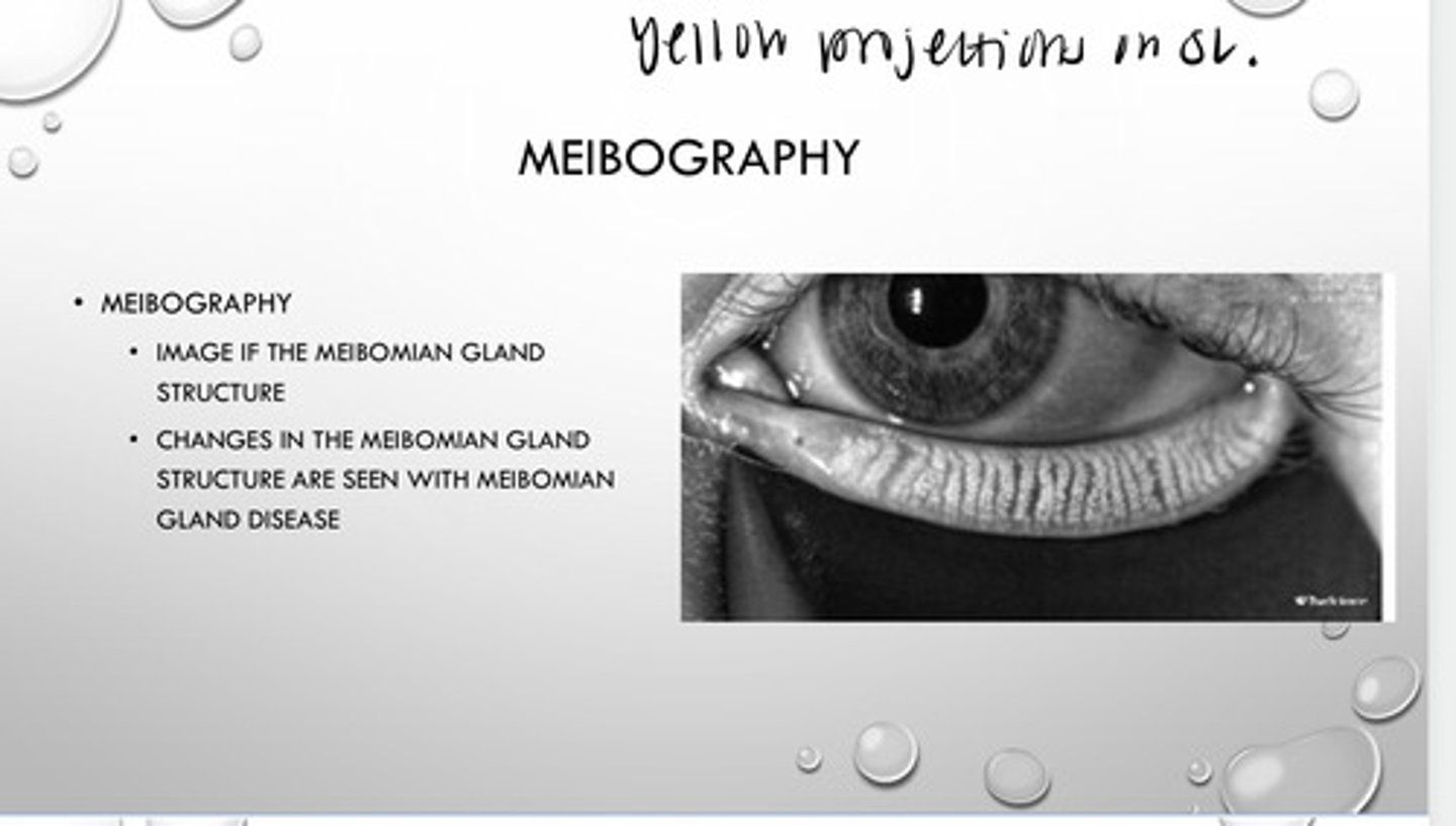 <p>image of the meibomian gland structure</p>