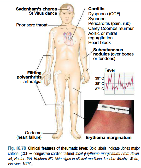 <ul><li><p>Fever, anorexia, lethargy and joint pain</p></li><li><p>5-15 years</p></li><li><p>Pleurisy, pleural effusion and pneumonia</p></li></ul><p>Pancarditis:</p><ul><li><p>Incidence decreases with age</p></li><li><p>Breathlessness (due to heart failure or pericardial effusion)</p></li><li><p>Palpitations or chest pain (due to pericarditis or pancarditis)</p></li><li><p>Tachycardia</p></li><li><p>Cardiac enlargement </p></li><li><p>New or changed murmurs (soft systolic murmur due to mitral regurgitation)</p></li><li><p>Valvulitis: Carey Coombs murmur (soft mid diastolic murmur)</p></li><li><p>Pericadial friction rub and precordial tenderness</p></li></ul><p>Arthritis:</p><ul><li><p>Commonest major manifestation</p></li><li><p>Occurs early when ASO titres are high</p></li><li><p>Acute painful, asymmetric and migratory inflammation of the large joints (knees, ankles, elbows and wrists)</p></li><li><p>Joints red, swollen and tender</p></li><li><p>Jaccoud’s arthritis</p></li><li><p>Dramatic response to salicylates</p></li></ul><p>Skin lesions:</p><ul><li><p>Erythema marginatum: Nonpruritic serpiginous or annular erythematous rash more prominent on the trunk &amp; inner proximal portions of the extremities.</p></li><li><p>Red macules that fade in centre but remain red at edges, occuring mainly on the trunk and proximal extremities but not face</p></li><li><p>Red rings or margins may coalesce or overlap</p></li><li><p>Subcutaneous nodules which are small (0.5-2.0 cm), firm and painless, best felt over extensor surfaces of bones or tendons - associated with severe carditis</p></li><li><p>Appear later (3 weeks)</p></li></ul><p>Syndenham’s chorea/ St Vitus dance:</p><ul><li><p>3 months after ARF episode, when all other signs may have gone</p></li><li><p>Common in women</p></li><li><p>Emotional lability is first feature</p></li><li><p>Purposeless, involuntary, choreiform movements of hands, feet or face</p></li><li><p>Speech may be explosive or halting</p></li><li><p>Spontaneous recovery</p></li><li><p>Milk maid grip, pronation of extended hands, wormian movements of tongue </p></li></ul><p></p>