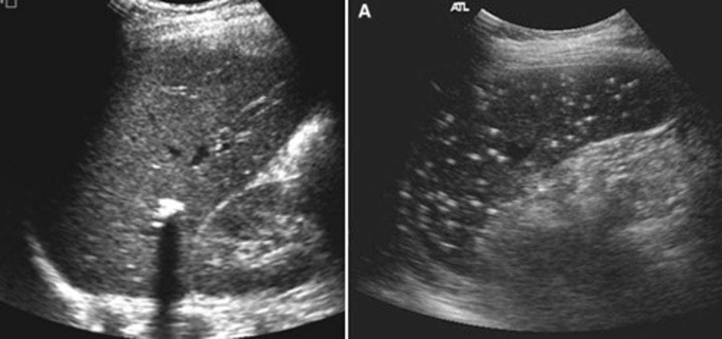 <p>Byproducts from inflammation present as hyperechoic masses throughout the liver</p><p>Vary in size, shadowing depends on size</p>