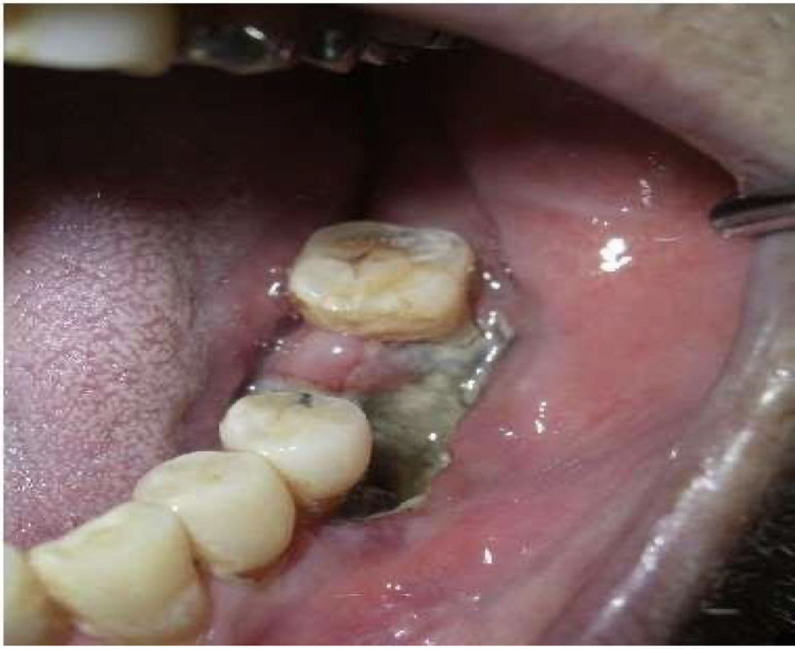 <p>A 45 year old with severe pain and swelling in 35 region of 2 weeks duration. The patient also presents with fever chills, and lymph node enlargement on same side. Intraorally accumulation of pus along with fetid odor could be noted. Provide differential diagnoses</p>