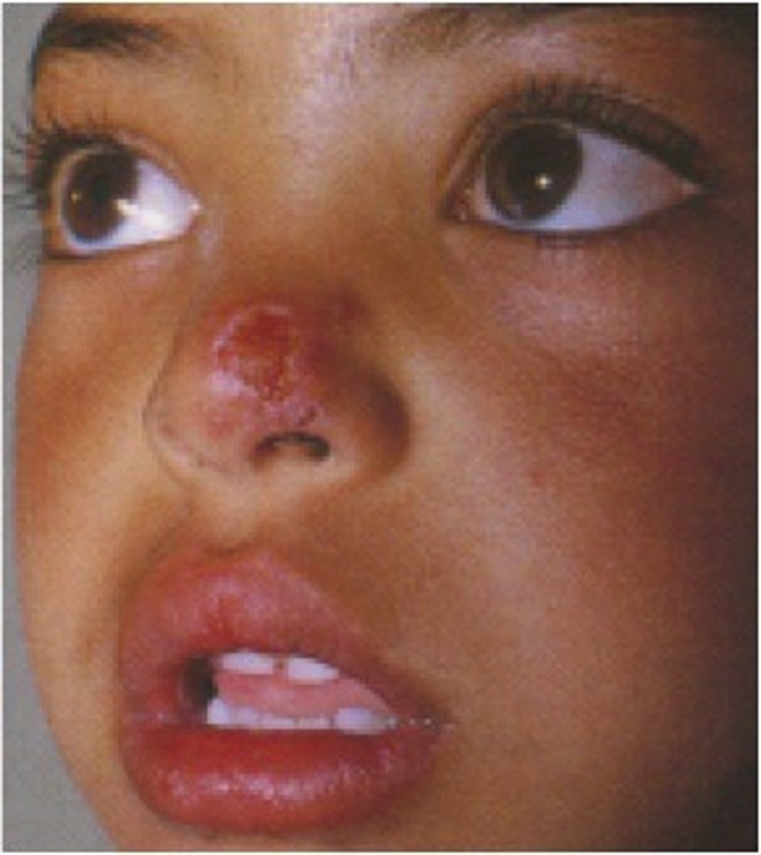 <p>Protozoan disease carried by sand flies, volcano like edges with central crater</p>