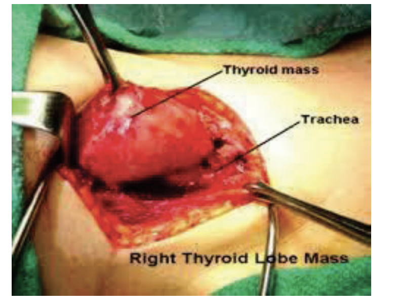 <p><strong>Diseased gland may lose its mobility and not move up when the patient swallows; indicative of a tumorous growth </strong></p><p><strong>Only 4-5% of thyroid nodules are cancerous</strong></p>