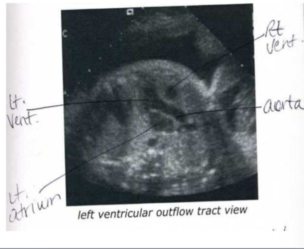 <p>What is LVOT?</p>