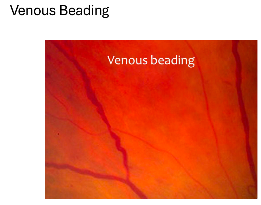 <p>weakening of venous walls and sludging/thickening of blood</p><ul><li><p>affects retinal veins/venules</p></li><li><p>appears as sausaing</p></li></ul><p></p>