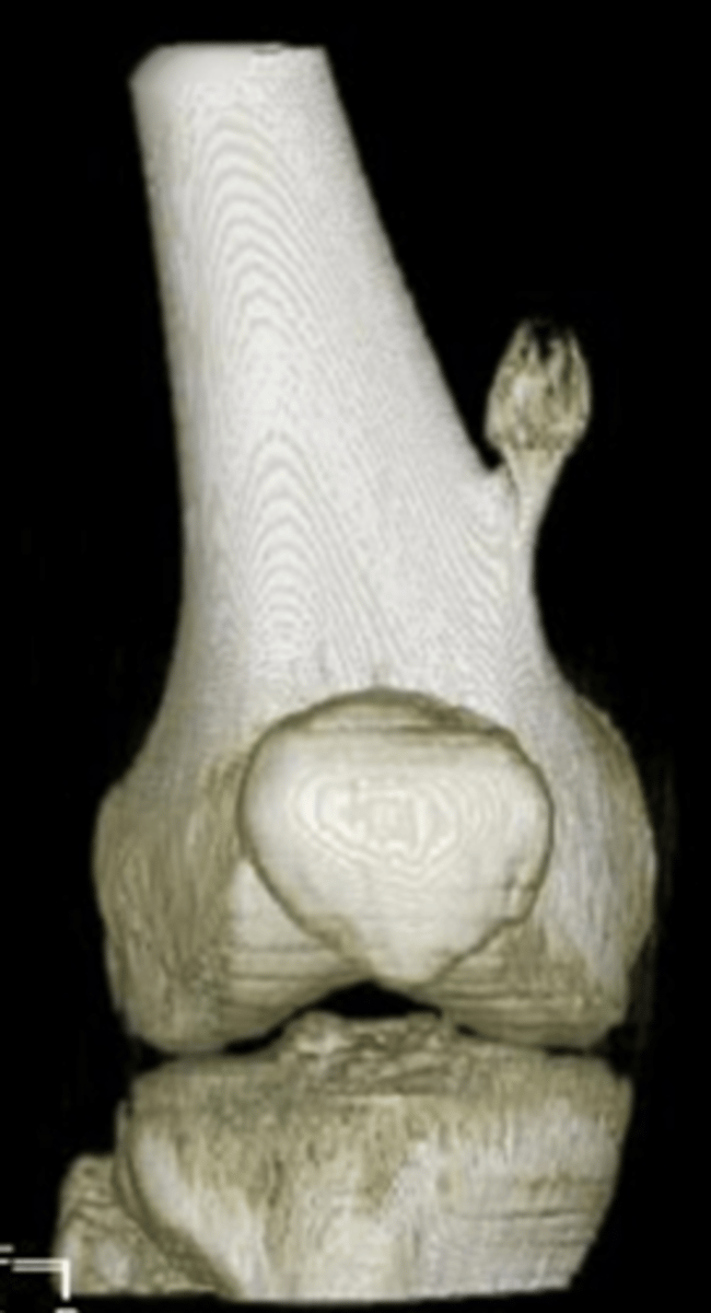 <p>State the clinical features of solitary osteochondroma</p>