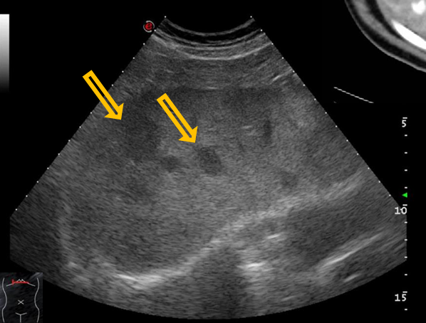 <p>Patient history: colorectal tumor, increased CEA level at present</p><p> Modality: Liver ultrasound with convex probe (3.5-5 MHz), B-mode </p><p>Region: liver, right subcostal view</p><p> Radiologic sign: Diagnosis: hypoechoic lesions of the liver multiple liver metastases</p>