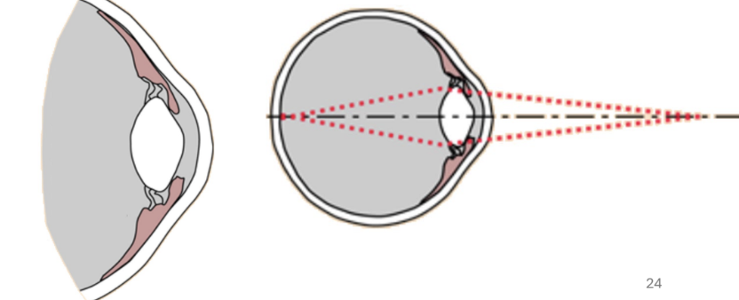 <ul><li><p>relaxation of lens</p><ul><li><p>now more curved</p></li></ul></li><li><p>see closer objects in focus </p></li></ul><p></p>