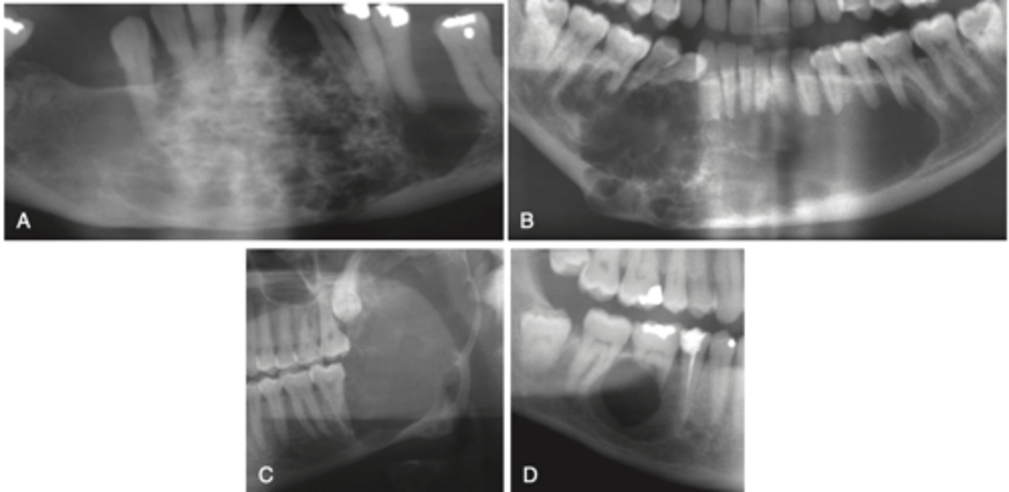 <p>OKC</p><p>Odontogenic myxoma</p><p>Aneurysmal bone cyst</p><p>CEOT</p><p>Dentigerous cyst</p><p>Central giant cell granuloma</p><p>Ossifying fibroma</p>
