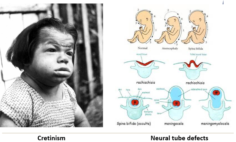 <ul><li><p class=""><strong>Iodine deficiency</strong> = congenital cretinism, brain development delay</p></li><li><p class=""><strong>Folate deficiency</strong> = neural tube defects</p></li></ul><p></p>