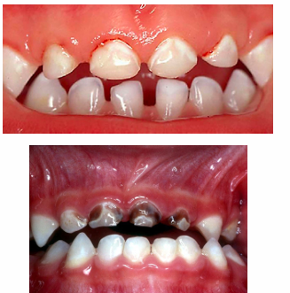 <p>-presence of one or more decayed, missing, or filled tooth surfaces (dmft) in any primary tooth in a child under six</p><p>-decay can be noncavitated or cavitated</p><p>-missing due to caries (not due to trauma)</p>