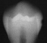 <p>classify this according to radiographic presentation of the ADA </p>