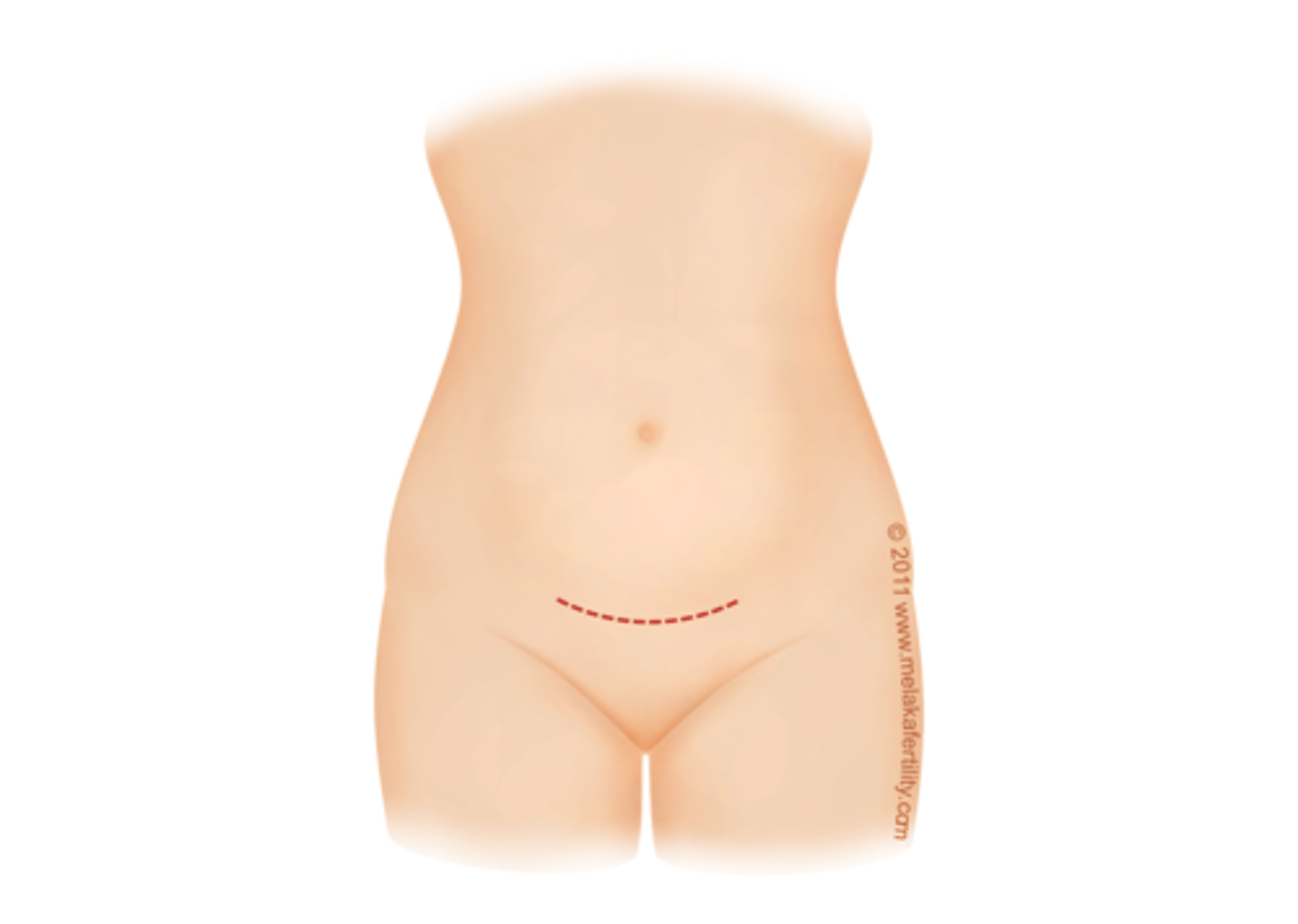 <p>Incision used for c-sections</p><p>a. McEvedy</p><p>b. Lanz</p><p>c. Midline</p><p>d. Pfannenstiel</p>