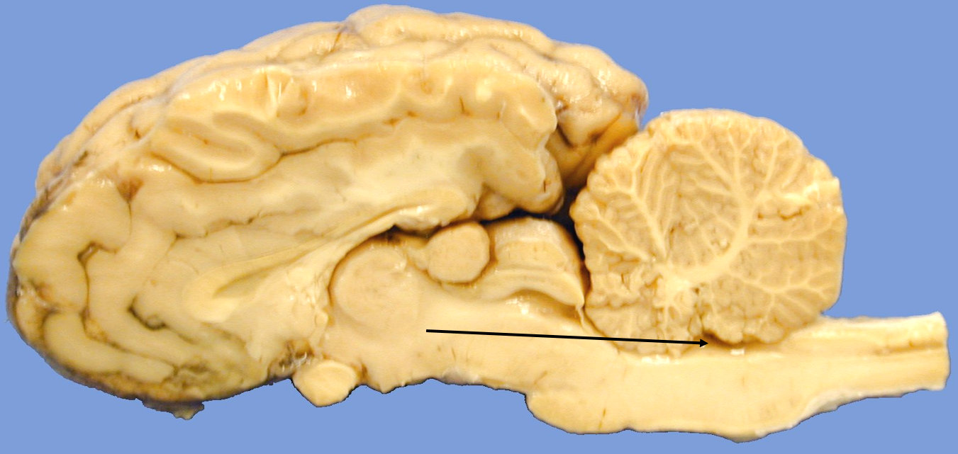 <p>fourth ventricle</p>