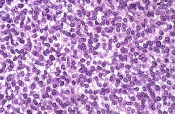 <p>Ewing Sarcoma Histology - This is a tumor that was isolated from bone.  What type of tissue is missing?</p>